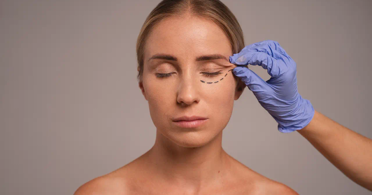 Blepharoplasty